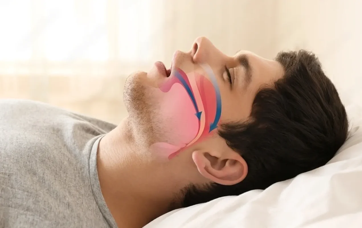 Snoring and Sleep Apnea